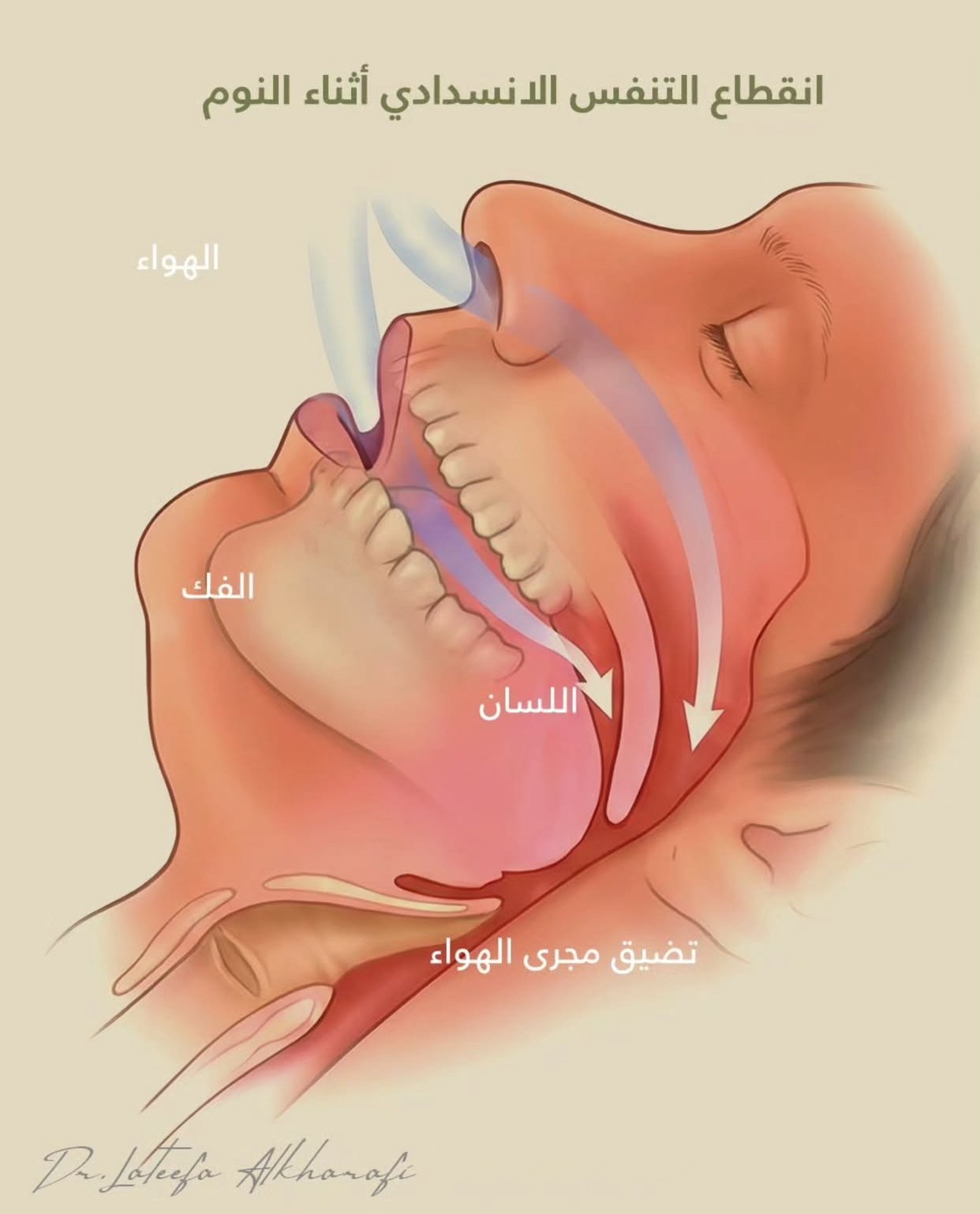 انقطاع التنفس أثناء النوم عند البالغين